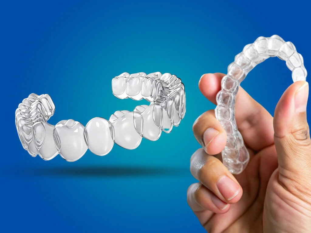 Aligners in ongole